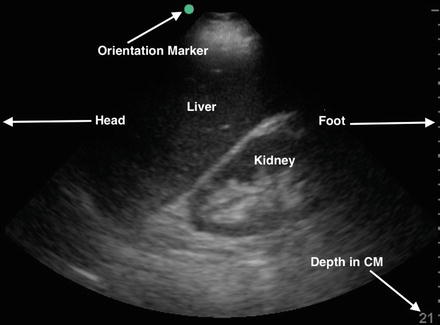 Ultrasound Whole Abdomen